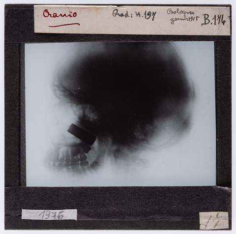 RGD-S-00B174-1976 - Radiografia di un cranio umano - Data dello scatto: 01/1915 - Archivi Alinari, Firenze