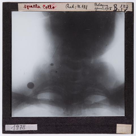 RGD-S-00B179-1978 - Radiografia di una spalla e collo umano - Data dello scatto: 01/1915 - Archivi Alinari, Firenze