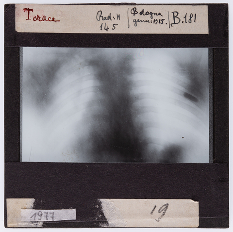 RGD-S-00B181-1977 - Radiografia di un torace umano - Data dello scatto: 01/1915 - Archivi Alinari, Firenze