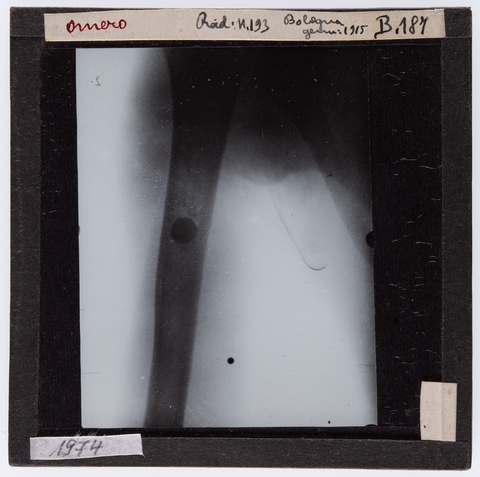 RGD-S-00B187-1974 - Radiografia di un omero umano - Data dello scatto: 01/1915 - Archivi Alinari, Firenze