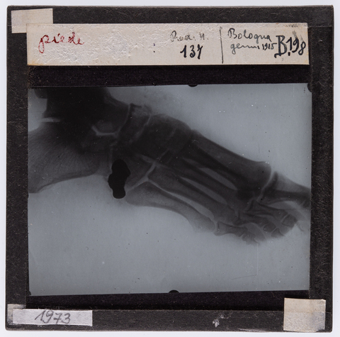 RGD-S-00B198-1973 - Radiografia di un piede umano - Data dello scatto: 01/1915 - Archivi Alinari, Firenze