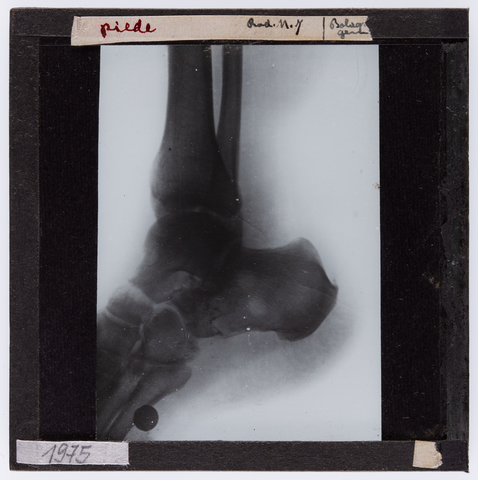 RGD-S-SN0000-1975 - Radiografia di un piede umano - Data dello scatto: 01/1915 - Archivi Alinari, Firenze